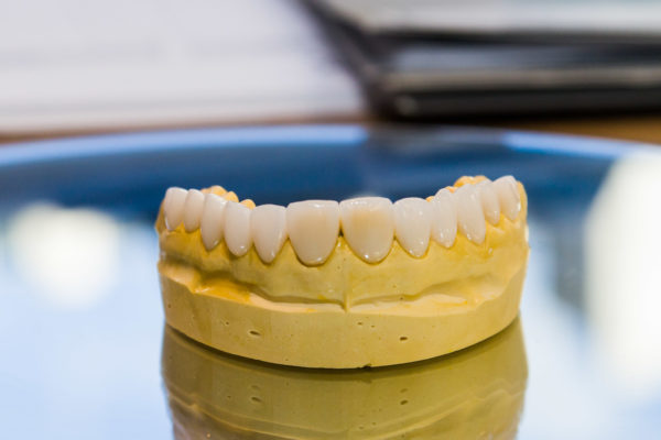 Molde dente by Dr. Alysson Resende