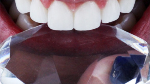Teste Clareamento Doctor Alysson Resende - Ortodontista e Dentista em BH