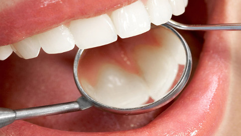 Teste Periodontia Doctor Alysson Resende - Ortodontista e Dentista em BH