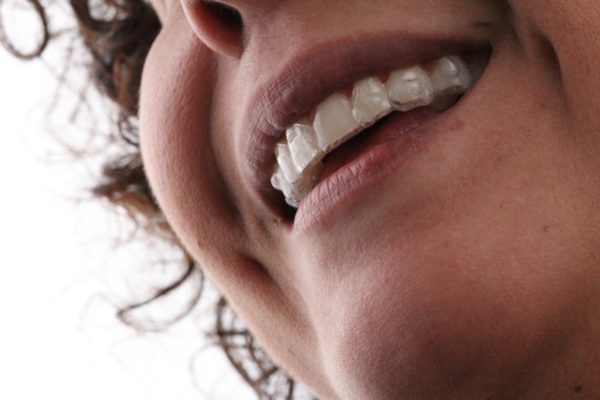 WhatsApp mulher sorrindo com invisalign Dr Alysson Resende