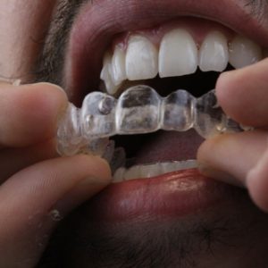 WhatsApp homem de barba invisalign Dr Alysson Resende