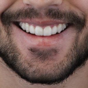 WhatsApp homem de barba invisalign odontologia Dr Alysson Resende