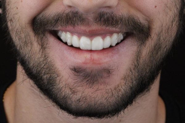WhatsApp homem de barba invisalign odontologia Dr Alysson Resende