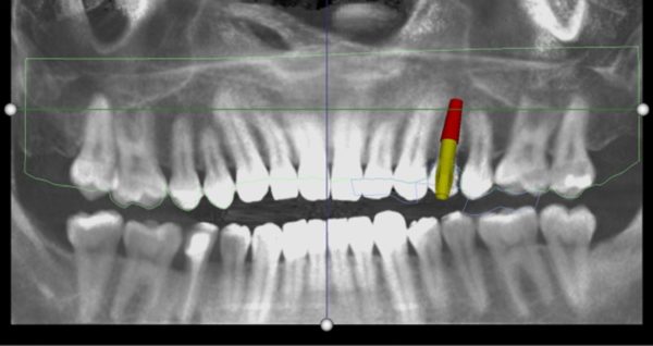 A tecnologia 3D no implante dentário