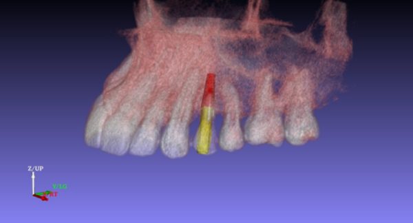 A tecnologia 3D no implante dentário