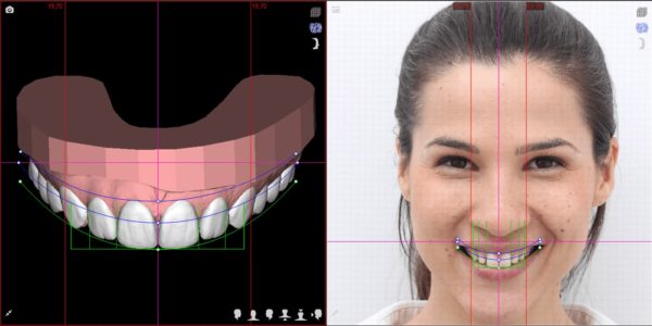 Digital Smile Design - DSD