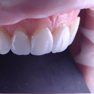 Sorriso hi-tech, técnica Digital Smile Design - DSD