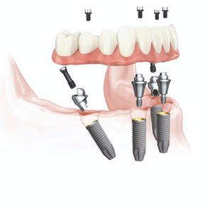 A Nobel Biocare é a mais nova parceira da AR Odontologia