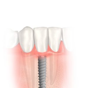 A Nobel Biocare é a mais nova parceira da AR Odontologia