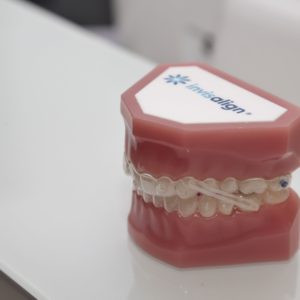 Invisalign BH, Tecnologia ortodôntica Dr. Alysson Resende