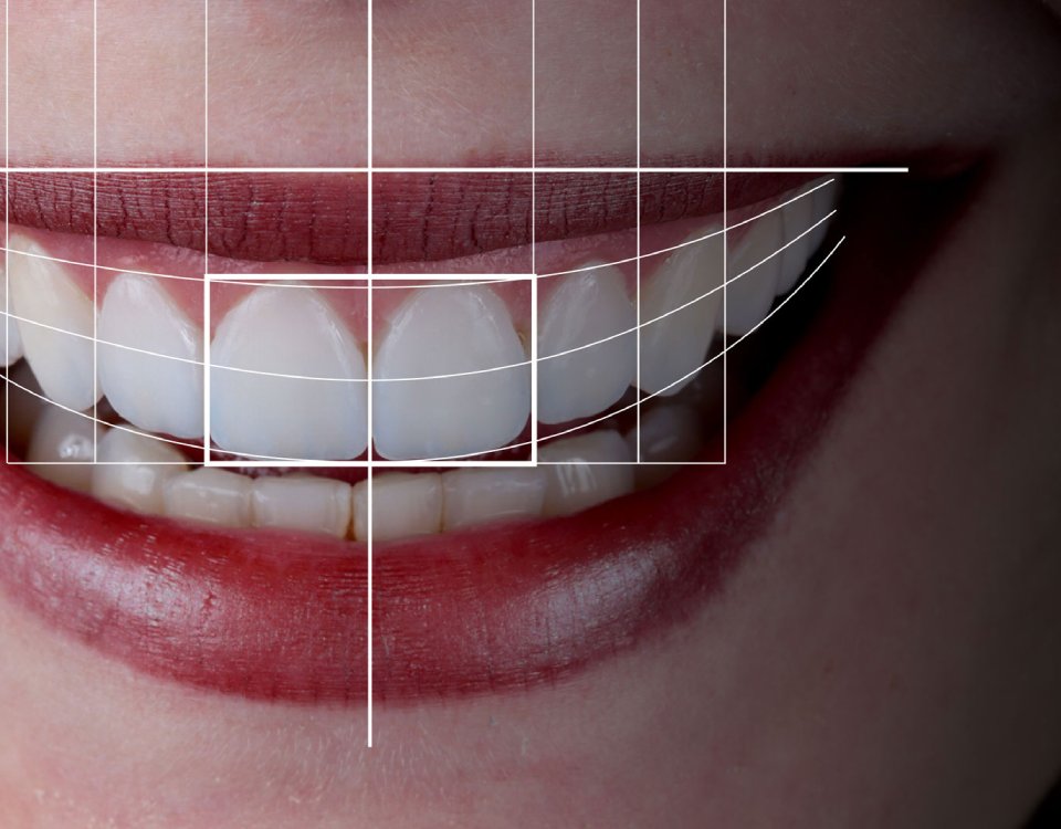 Sorriso hi-tech, técnica Digital Smile Design - DSD