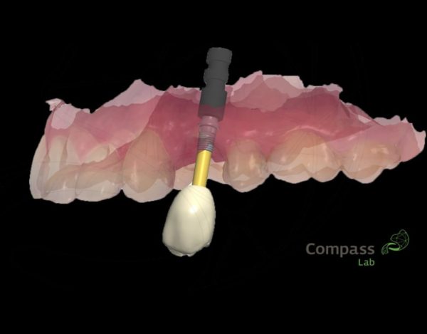 A tecnologia 3D no implante dentário