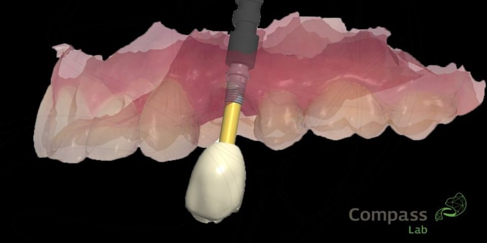 A tecnologia 3D no implante dentário
