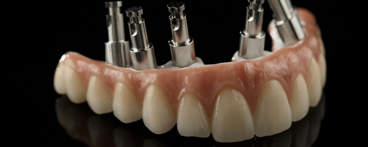 Como é feito o implante dentário total tipo protocolo?