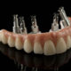 Como é feito o implante dentário total tipo protocolo?