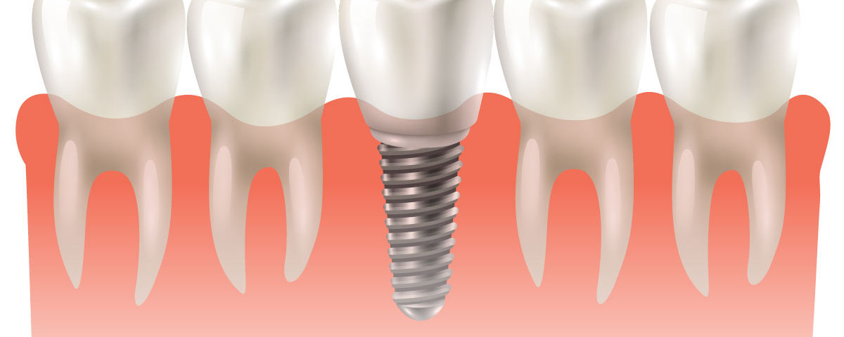 O que é implante dentário? Como funciona?