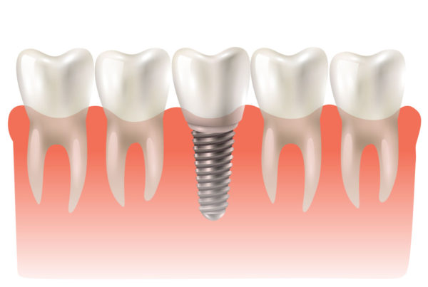 O que é implante dentário? Como funciona?