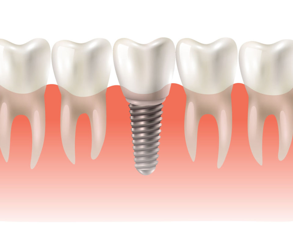 O que é implante dentário? Como funciona?
