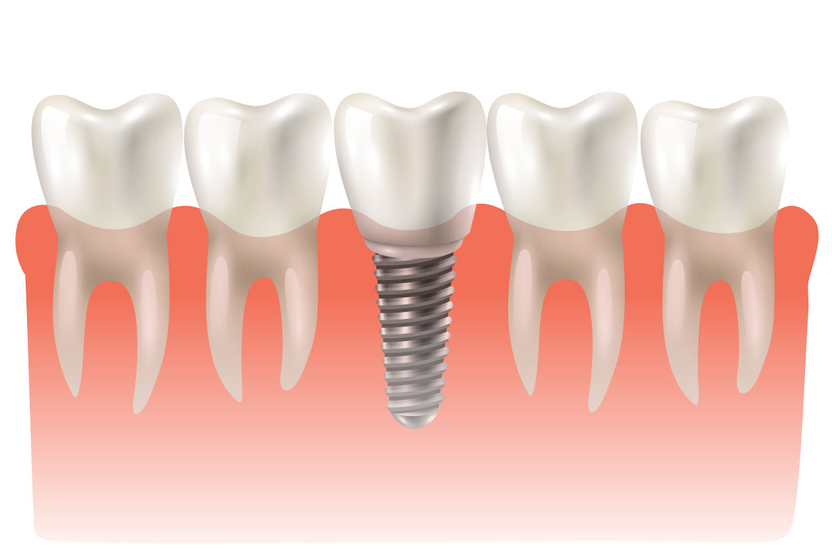 O que é implante dentário? Como funciona?