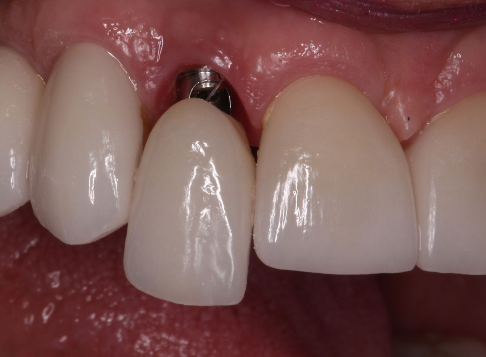 O que é cicatrizador de implante dentário?