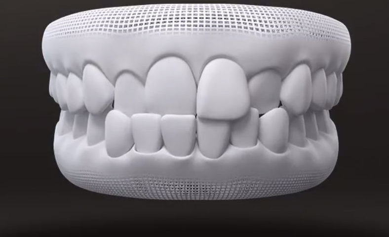 Posso tratar mordida cruzada com Invisalign?