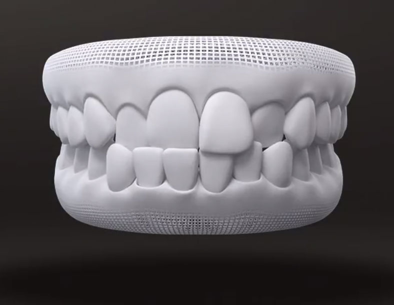 Posso tratar mordida cruzada com Invisalign?