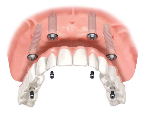Principais dúvidas sobre implante dentário – Parte 1