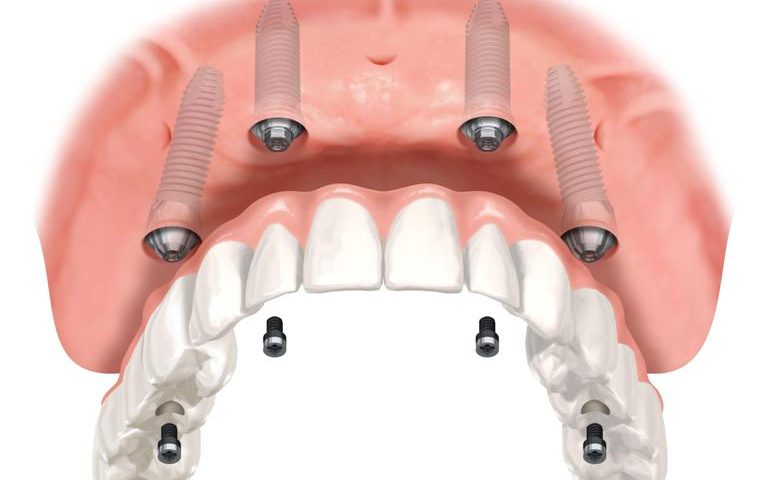Principais dúvidas sobre implante dentário – Parte 1