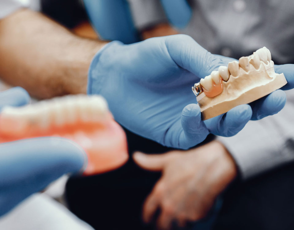 Principais dúvidas sobre implante dentário – Parte 2