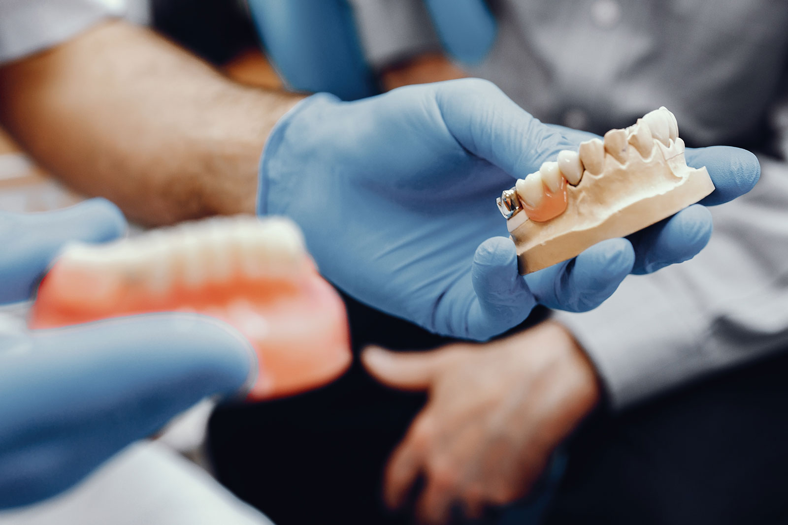 Principais dúvidas sobre implante dentário – Parte 2