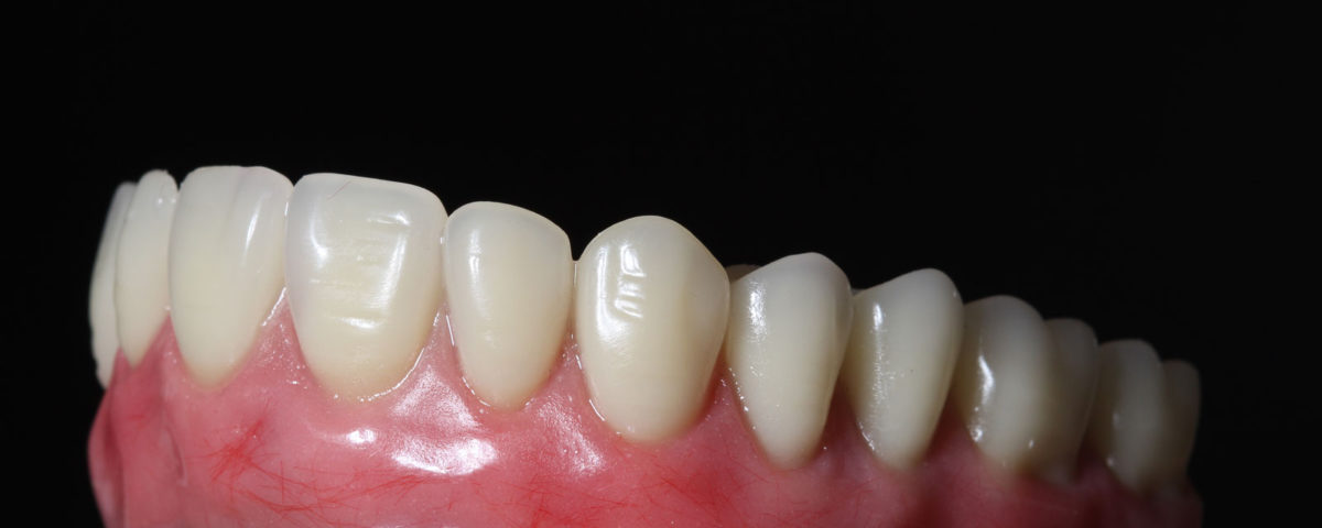 Qual o valor de implante dentário?