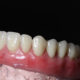 Qual o valor de implante dentário?